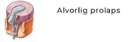 Diagram som viser et betydelig skiveprolaps.